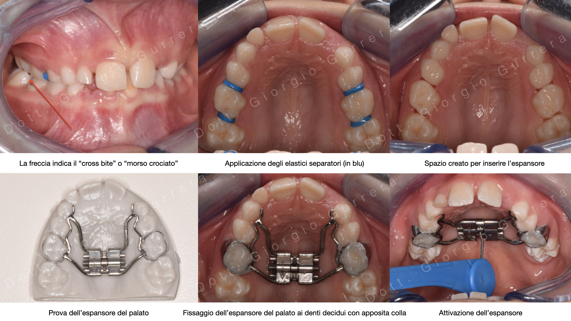 In questa immagine vengono illustrate tutte le fasi cliniche della consegna dell'espansore rapido del palato: dall'applicazione degli elastici separatori all'attivazione dell'espansore.