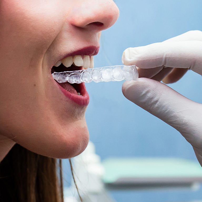 Ortodonzia Invisibile con Allineatori a Catania