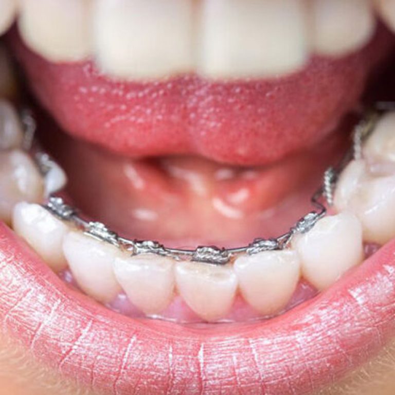 Ortodonzia invisibile linguale - Giorgio Gurrera