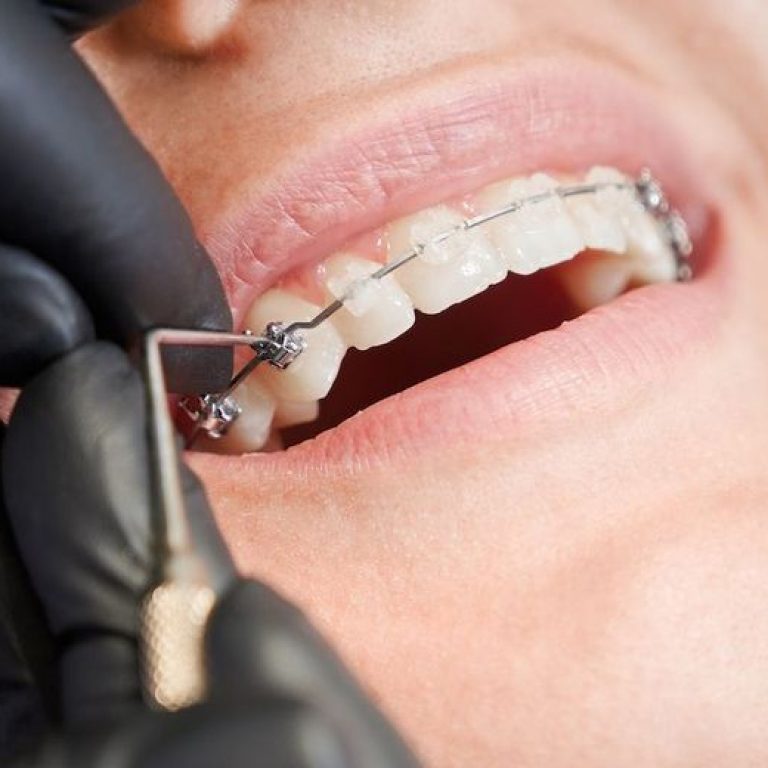 Ortodonzia tradizionale estetica con attacchi in ceramica trasparenti - Giorgio Gurrera